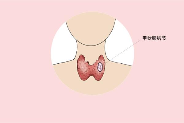 甲狀腺癌癥的主要癥狀表現(xiàn)有什么？為什么會(huì)得甲狀腺癌癥呢？
