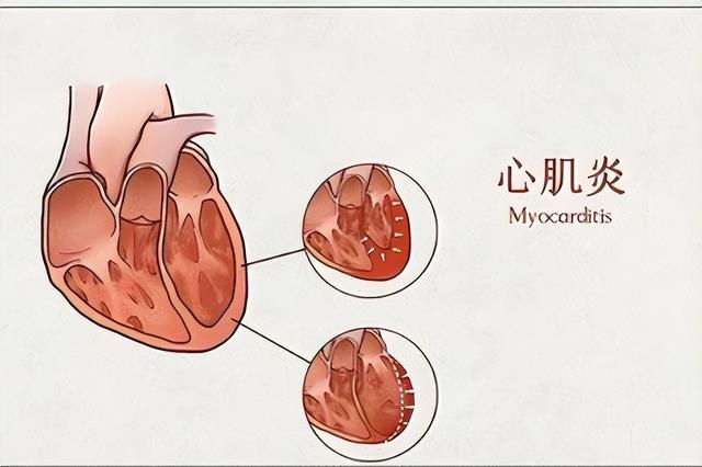 心肌炎的癥狀有哪些？心肌炎的主要變現(xiàn)癥狀有啥？